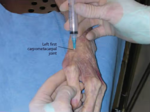 Procedimento de viscossuplementação na rizartrose com infiltração de ácido hialurônico na articulação CMC do polegar