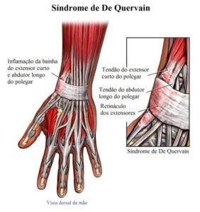 tendinite-de-de-quervain