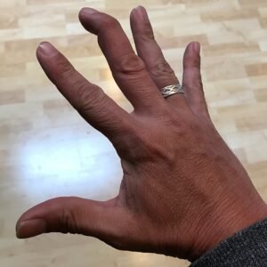 https://commons.wikimedia.org/wiki/File:Mallet_Finger_Injury.jpg