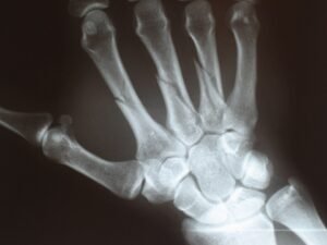 metacarpal fracture